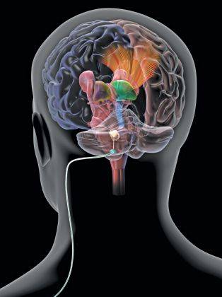 التحفيز الكهربائي العميق علاجاً لغيبوبة الدماغ